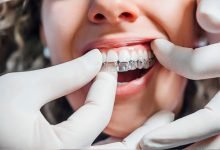 Doubts About Clear Aligners You Should Clarify