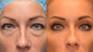 Photo of What Is The Procedure For Removing Eye Bags?